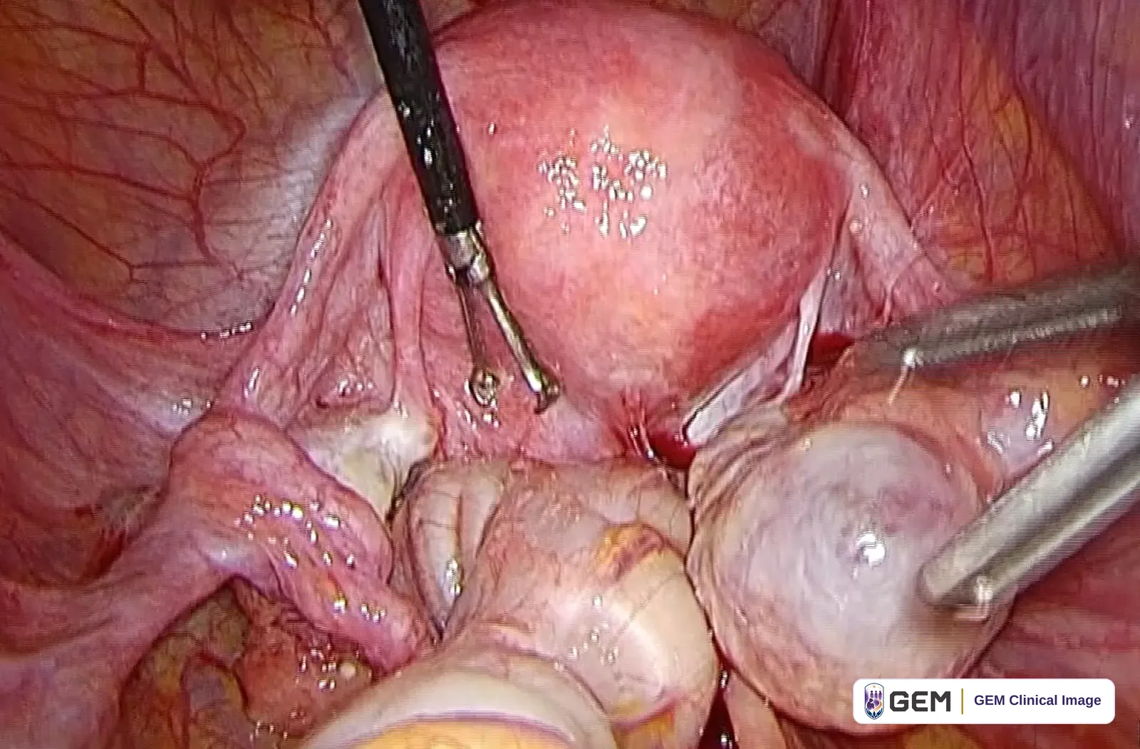 Laparoscopic view of pink pelvic tissue with two metal instruments; one instrument rests on a rounded pink-red structure at the centre and another holds a pale rounded structure at the lower right, with yellow fatty tissue beneath.