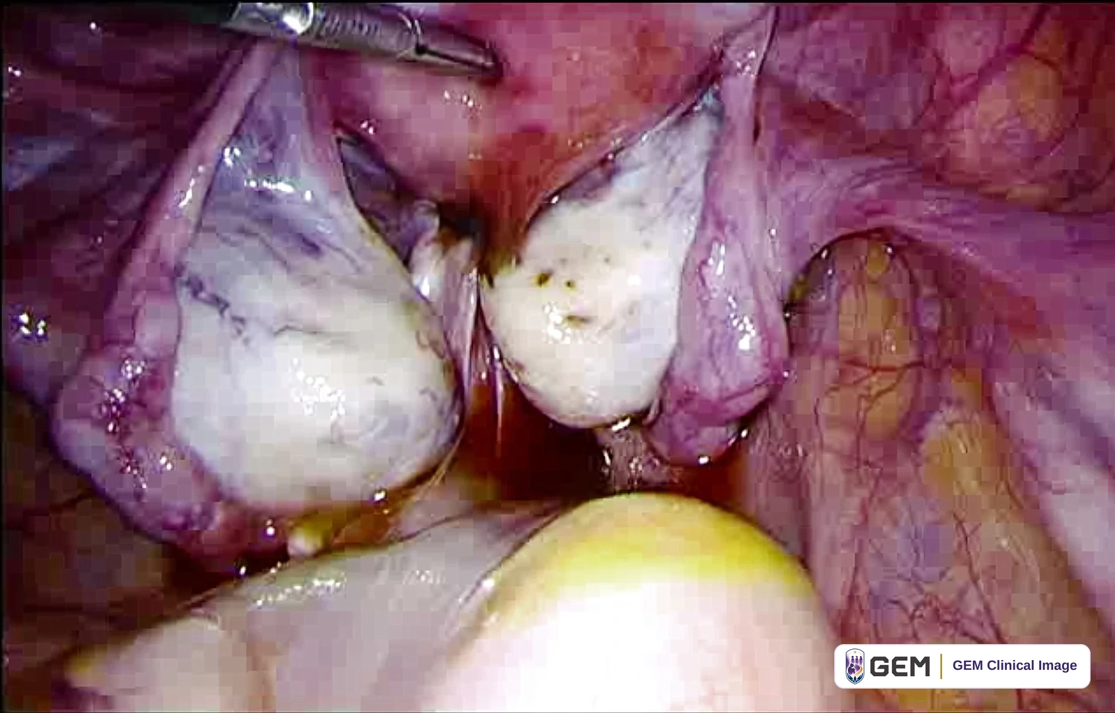Laparoscopic view of purple-pink pelvic tissue with two pale rounded structures side by side, a metal instrument at the top left and a yellowish surface at the lower right.