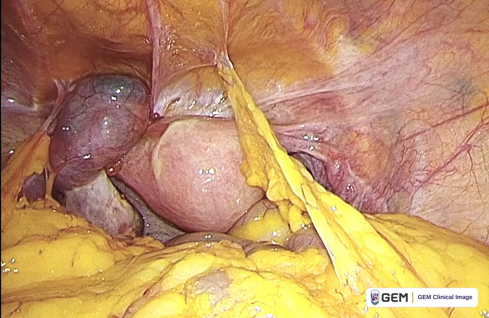 Laparoscopic view of a pink-purple rounded structure and pale pink tissue surrounded by yellow fatty tissue, with a band of tissue running across the upper right.