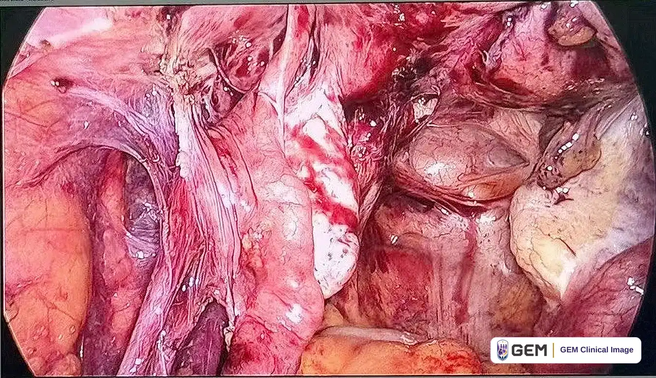 Laparoscopic view of red pelvic tissue with areas of pale tissue and blood at the centre and yellowish tissue along the lower edge.