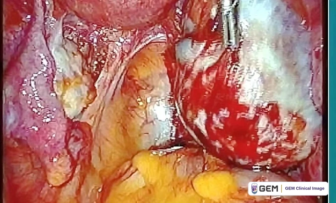 Laparoscopic view of pink and red pelvic tissue with a rounded dark red area on the right, pale membranes and yellow tissue in the lower part of the image.