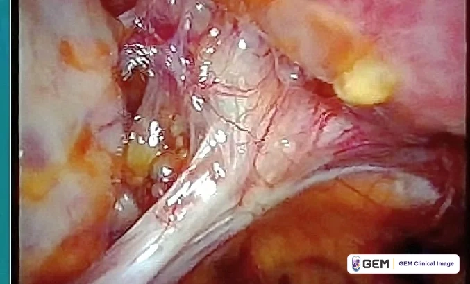 Laparoscopic view of glistening pink and pale tissue with a pale band of tissue running across the centre and yellow tissue at the edges.