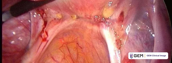Laparoscopic view of pink pelvic tissue with visible blood vessels, small dark red and yellow spots on the surface, and the tip of a surgical instrument at the top left.