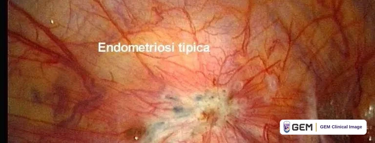Laparoscopic view of pink tissue with fine red blood vessels and a pale area near the centre containing dark blue-black and dark red spots, with the caption 'Endometriosi tipica' printed on the image.