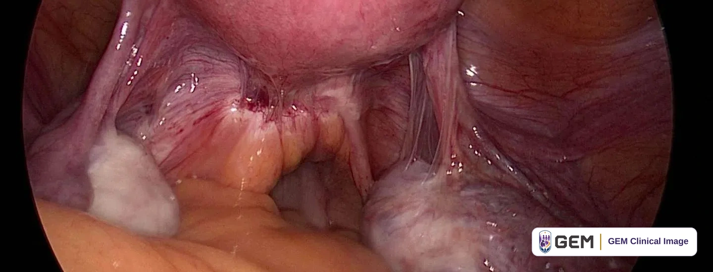 Laparoscopic wide view of pelvic organs: a smooth pink rounded structure at the top, glistening purple-red tissue with thin translucent bands stretched between structures, and pale white and yellow tissue in the lower part of the frame.