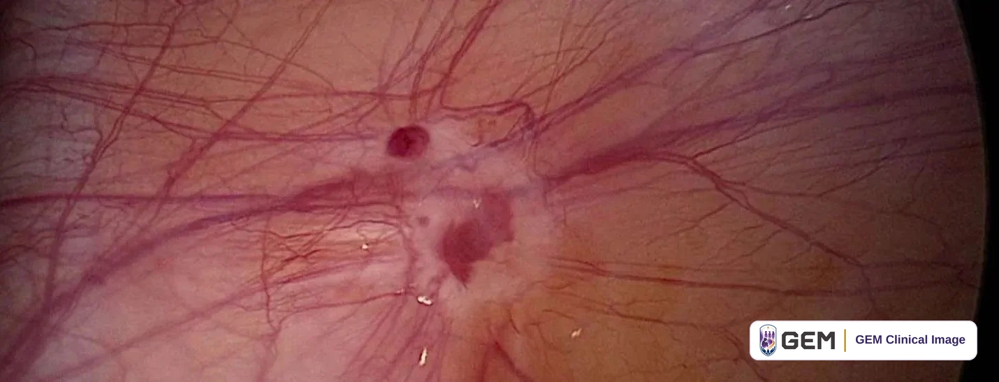Laparoscopic close view of a pale pink surface with a network of red vessels converging on a central pale patch that contains dark red spots.