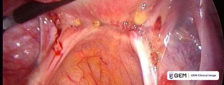 Laparoscopic view with a dark instrument tip entering from the upper left, a smooth pink rounded surface with yellow vessels below it, small yellow deposits and streaks of bright red along the upper edge.