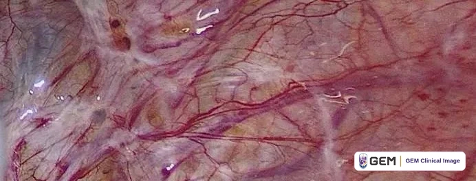 Laparoscopic close view of a purple-pink surface with branching red vessels, scattered brown patches and white reflective highlights.