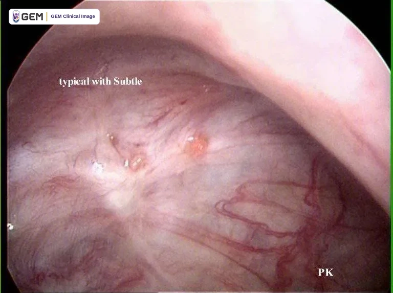 Laparoscopic view of pale pink tissue with fine red blood vessels and two small yellow-red spots near the centre; overlaid text reads “typical with Subtle” and “PK”.