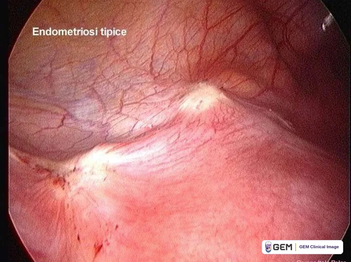 Laparoscopic view of pink tissue with a network of fine red blood vessels and a pale raised area at the centre; overlaid text reads “Endometriosi tipice”, with a faint watermark “Gruppo Italo Belga” at the lower right.