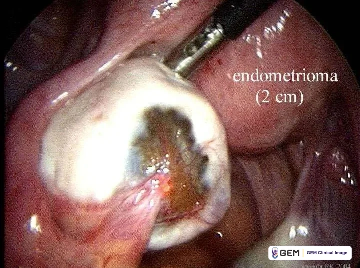 Laparoscopic view of a pale rounded structure held by a metal instrument, with a dark brown opening at its centre, surrounded by pink tissue; overlaid text reads “endometrioma (2 cm)” and “copyright P.K. 2004”.
