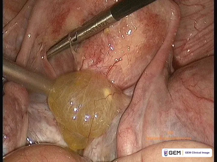 Laparoscopic view of a yellowish translucent rounded structure between folds of pink tissue, with two metal instruments entering from the upper left; faint orange overlay text at the lower right is only partly legible.