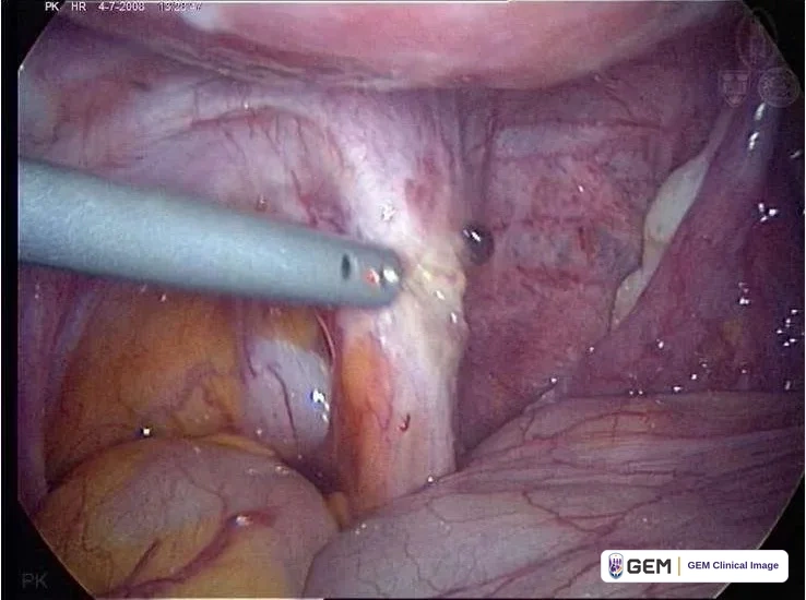 Laparoscopic view of pink and purple tissue with a grey instrument entering from the left, yellow tissue at the lower left and a small dark spot near the instrument tip; overlaid text reads “PK HR 4-7-2008” with a time stamp, and “PK” at the lower left.