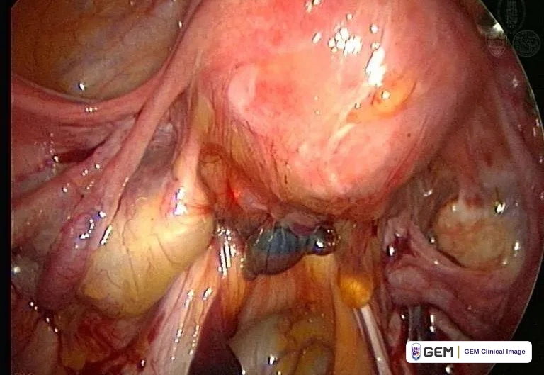Laparoscopic view of a rounded pink structure at the centre surrounded by pink, yellow and pale tissue, with a small dark blue-grey area beneath it and a faint circular emblem at the upper right.