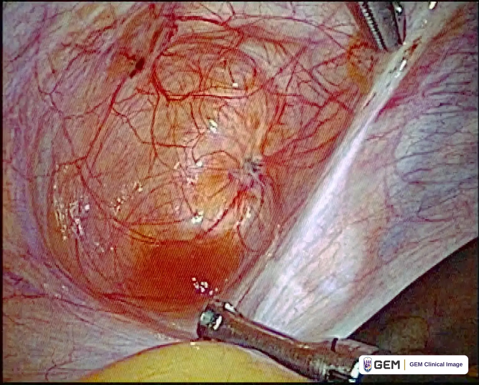 Laparoscopic view of a pink rounded surface covered by a fine network of red blood vessels, with a small dark red raised area at the centre, a dark spot at the upper left, a metal instrument entering from the lower right and yellow tissue at the lower left.