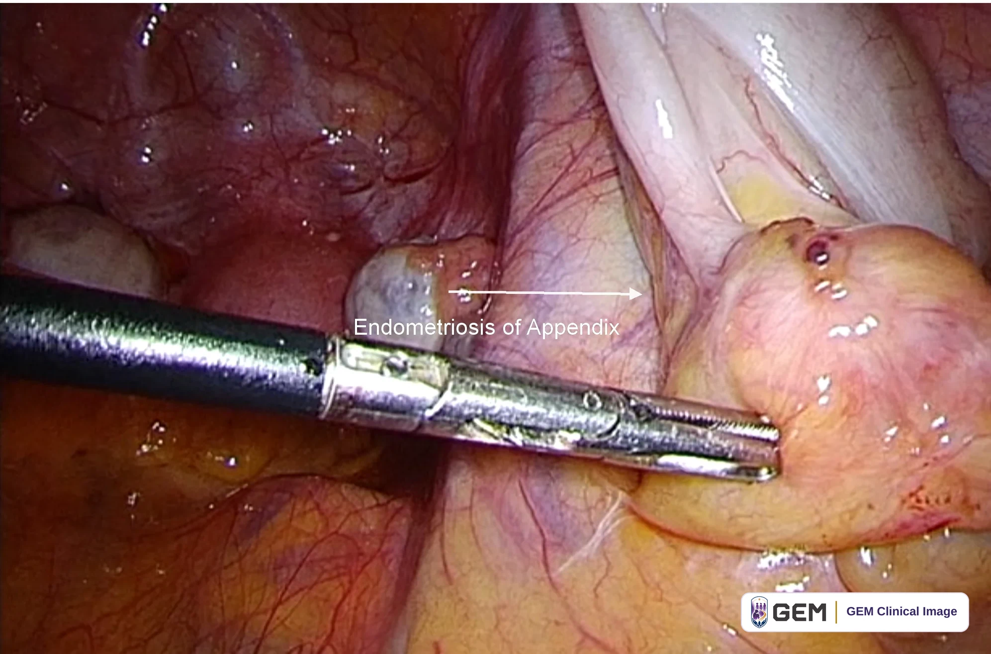 Laparoscopic view with a dark metal grasping instrument entering from the left towards a rounded pink-yellow structure at the right; a small bluish-grey rounded nodule sits near the centre, with the burned-in label “Endometriosis of Appendix” and a white arrow pointing from it towards the structure at the right.