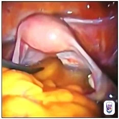 Laparoscopic view of a pale pink rounded structure at the upper centre with a thin curved tubular structure beside it, a dark instrument entering from the left and yellow tissue across the lower left; small, low-resolution image.