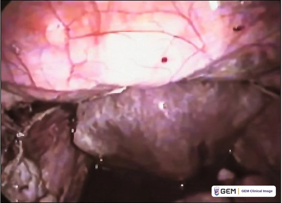 Laparoscopic view of a pale pink glossy surface with fine red blood vessels and a few small dark red spots in the upper half, above a darker grey-brown lobulated surface in the lower half.