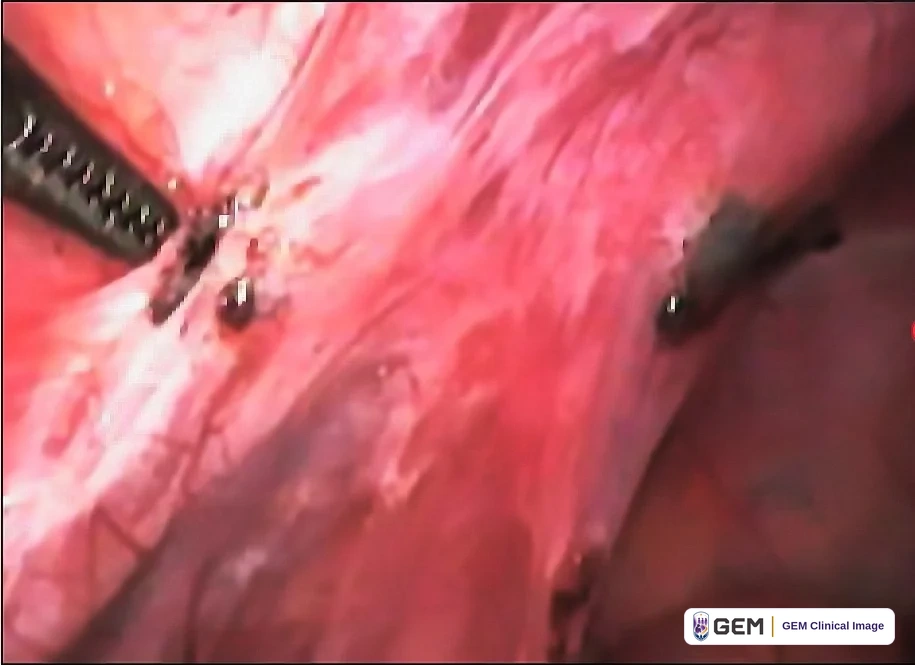 Laparoscopic view of pink tissue with a serrated metal instrument entering from the upper left; several small dark spots lie near the instrument tip and one dark brown-black patch lies to the right of centre.