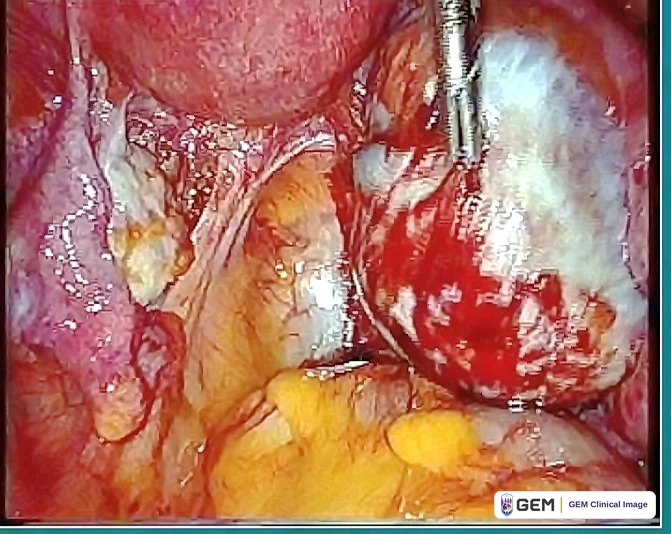 Laparoscopic view of a dark red rounded structure at the right, held against a metal instrument entering from above, with pink tissue at the upper left, glossy pale strands at the centre and yellow tissue across the lower part.