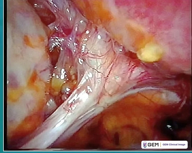 Laparoscopic view of pale glossy fibrous strands running diagonally across the centre between pink and orange-yellow tissue, with a small yellow nodule at the upper right and dark red areas at the lower right.