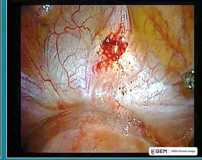 Laparoscopic view of a pale pink-yellow surface with a network of fine red blood vessels and a small dark red raised area at the upper centre, with the tip of a metal instrument at the right edge.