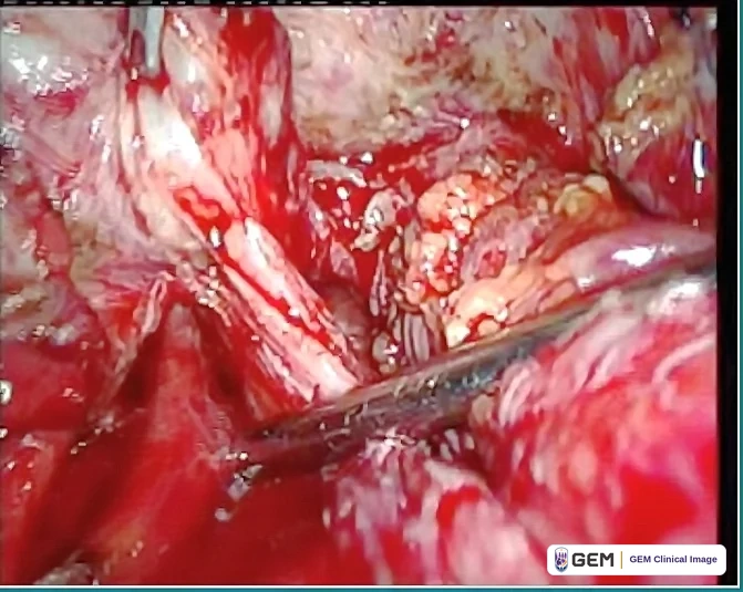 Laparoscopic view of red and pink tissue with a pale band running diagonally from the upper left to the centre, a pale yellow-pink lobulated mass at the centre right and a grey instrument entering from the lower right.