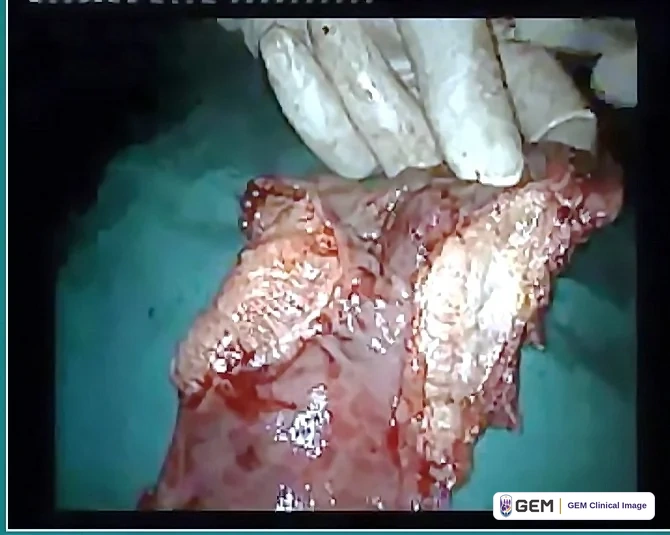 Photograph of a pink-red tissue specimen lying on a green surgical drape, held at the top by a gloved hand; a strip of partly cropped, illegible overlay text runs along the top edge.