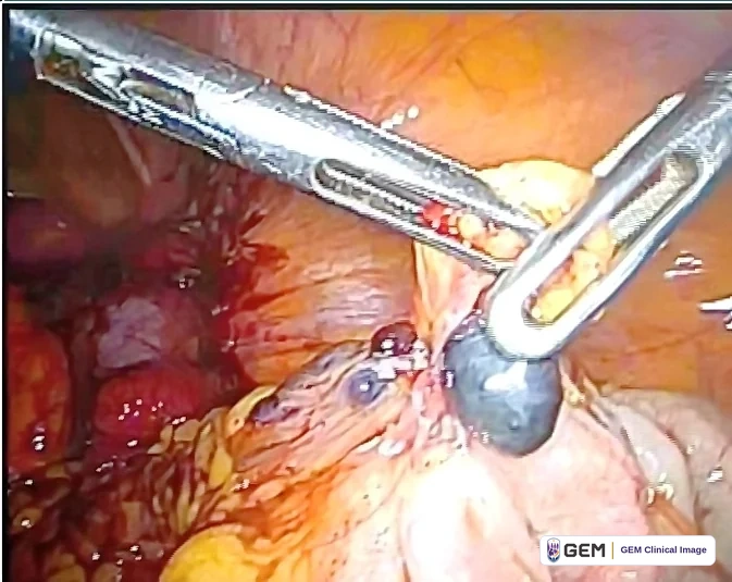 Laparoscopic view of a metal grasping instrument entering from the upper left and holding a small pale yellow area, with a dark blue-grey rounded structure below it, pink and yellow tissue across the lower half and dark red tissue at the left.