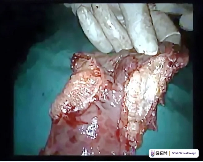 Photograph of a length of pink and red tissue with an irregular, glistening surface, held at the top by gloved fingers against a blue-green surgical drape.