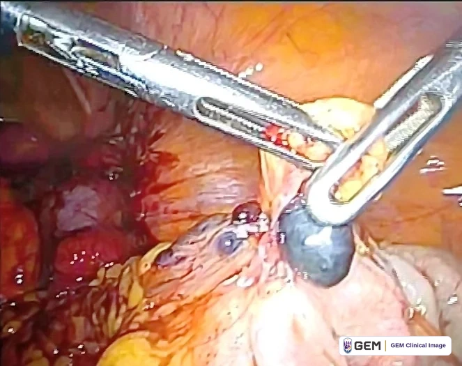 Laparoscopic view with two metal instruments entering from the upper left and right and grasping pale pink tissue; dark red and purple tissue and yellow fatty tissue lie behind, with a rounded dark grey object near the centre.