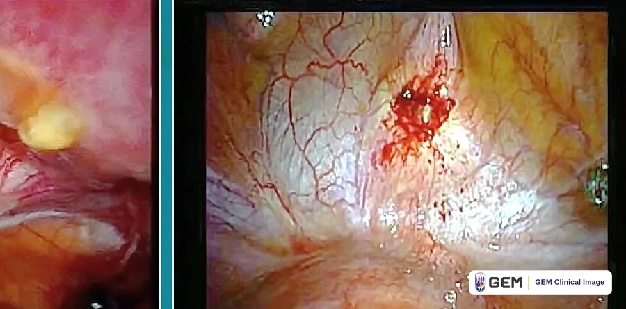 Composite laparoscopic image: a narrow strip at the left shows pink tissue with a small pale yellow deposit; the larger panel at the right, separated by a teal vertical bar, shows a pale pink glistening surface with branching red vessels and a small dark red patch near the centre.