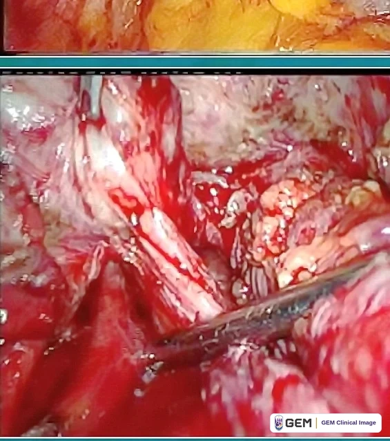 Composite laparoscopic image with a thin strip of yellow tissue across the top; the main panel shows a deep red operative field with pale pink and white cord-like structures, glistening yellow-white nodular tissue at the right, and the shaft of a dark instrument entering from the lower right.