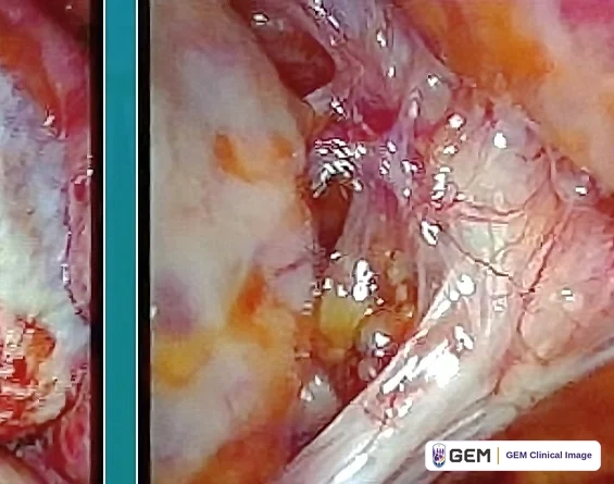 Composite laparoscopic image: a narrow strip at the left shows pink and red tissue; the main panel, separated by a teal vertical bar, shows glistening pale pink and white fibrous bands with yellow fatty tissue and small pale yellow deposits near the centre.