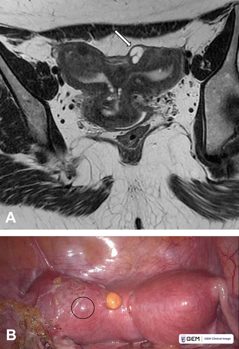 Two-panel composite image. Panel A: a black-and-white pelvic MRI scan with a white arrow pointing to a small bright rounded area at the upper edge of the uterus. Panel B: a laparoscopic view of pink pelvic tissue with a black circle drawn around a small raised area and a yellow rounded structure beside it.