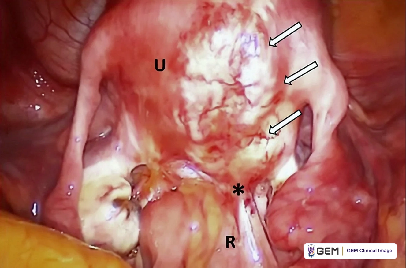 Laparoscopic view of pink-red pelvic tissue with a large pale rounded structure at the centre labelled U, three white arrows pointing to its right-hand surface, an asterisk below it, and the letter R over lower tissue; yellow fatty tissue at the lower left.