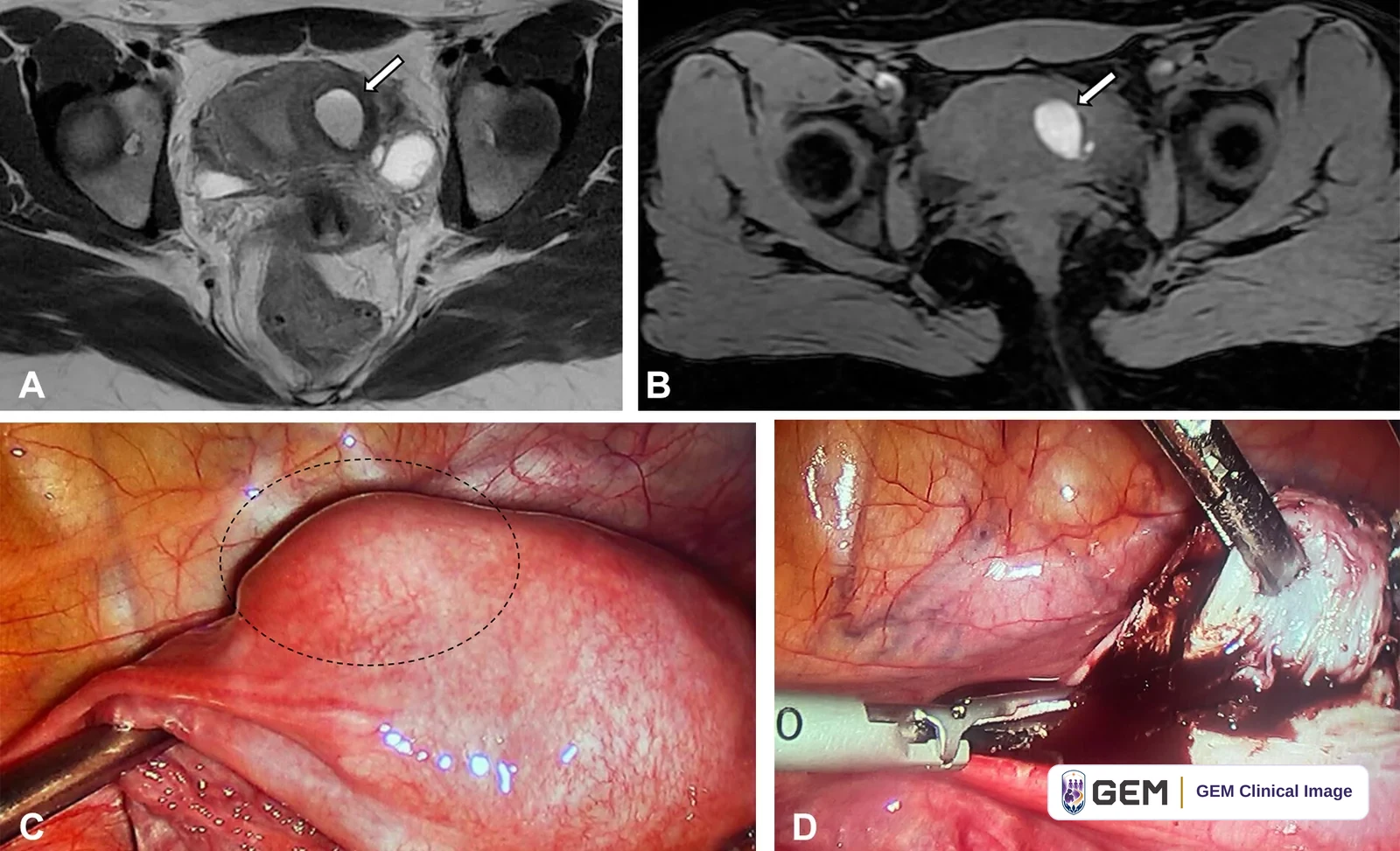 Four-panel composite image. Panels A and B: black-and-white pelvic MRI scans, each with a white arrow pointing to a small bright rounded area in the uterine wall. Panel C: a laparoscopic view of a smooth pink rounded structure with a dashed black oval drawn on its surface. Panel D: a laparoscopic view with two metal instruments holding a pale tissue fragment against dark red tissue.